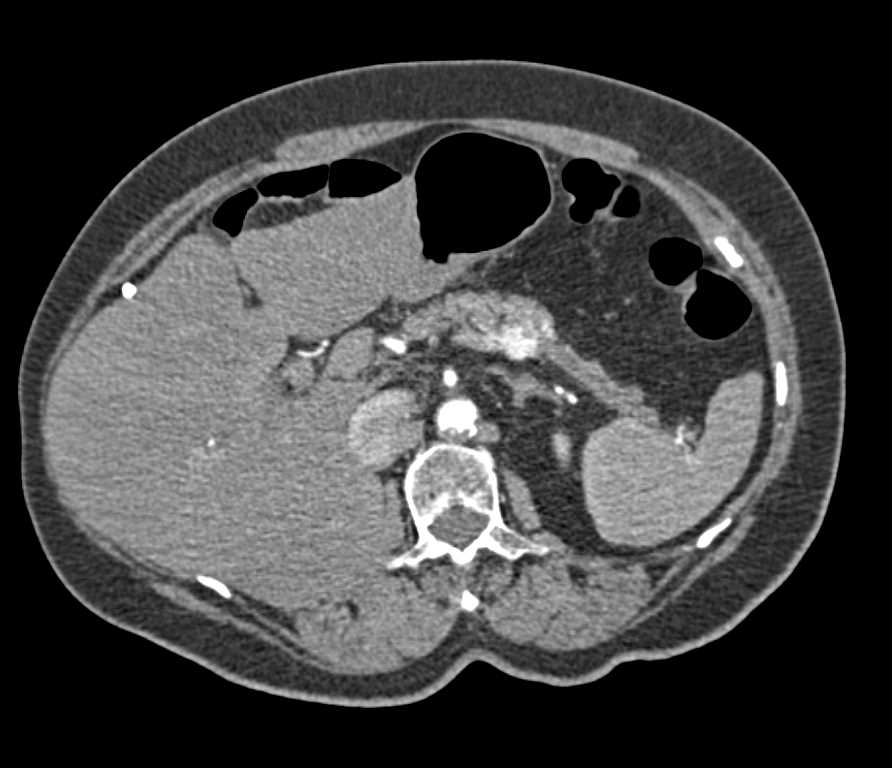 Metastatic Renal Cell Carcinoma with Pancreatic Metastases - CTisus CT Scan