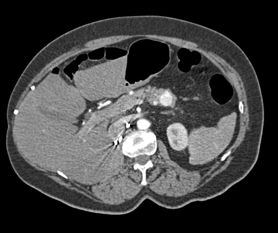 Metastatic Renal Cell Carcinoma with Pancreatic Metastases and Contralateral Renal Metastases - CTisus CT Scan