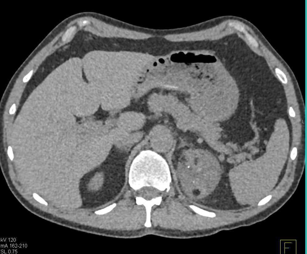 Myelolipoma Left Adrenal Gland - CTisus CT Scan