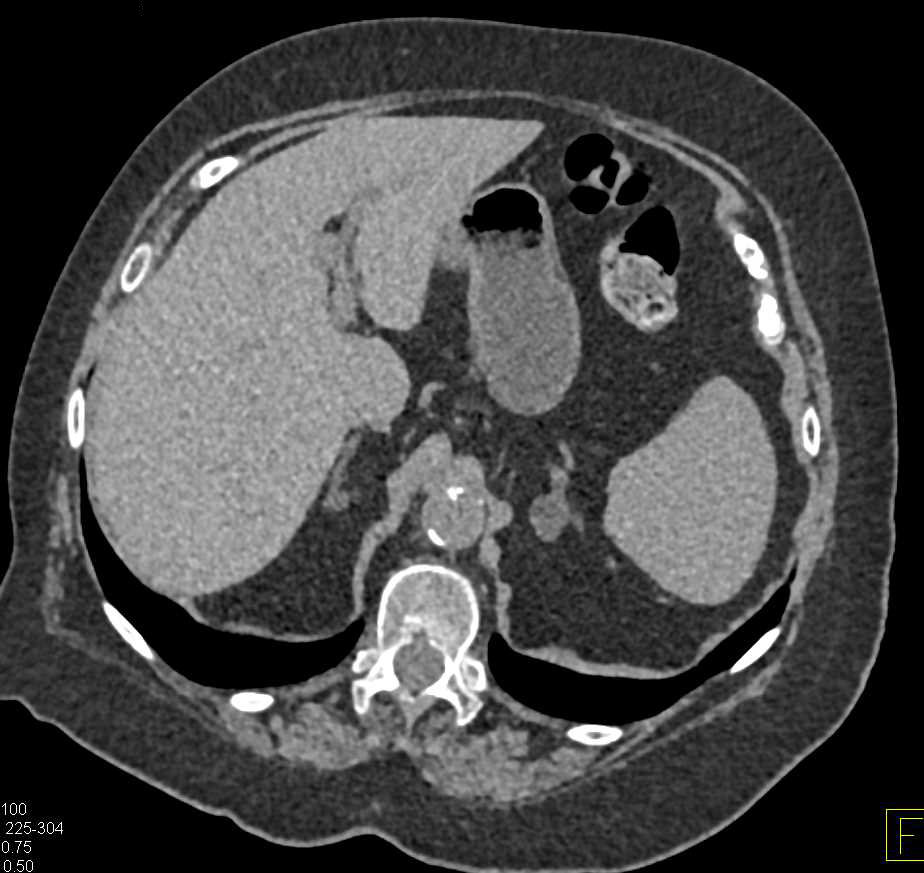 Bilateral Adrenal Adenomas - CTisus CT Scan