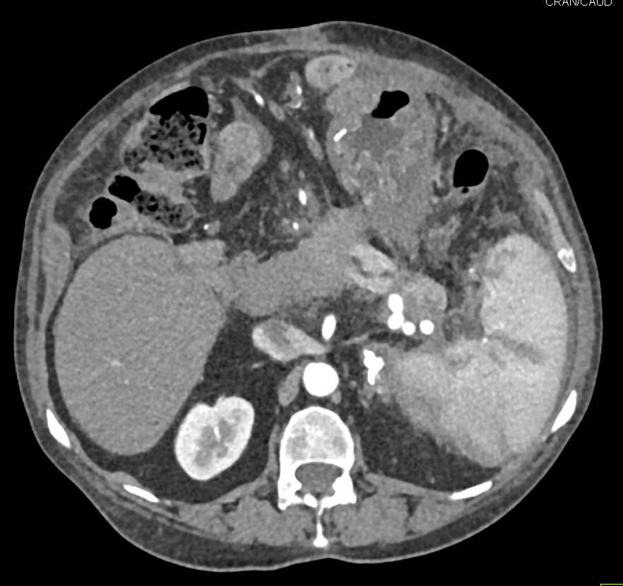 Calcified Adrenals due to Old Granulomatous Disease - CTisus CT Scan