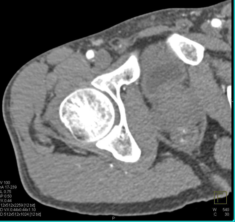 Vascular Occlusion Posterior Tibial Artery - CTisus CT Scan