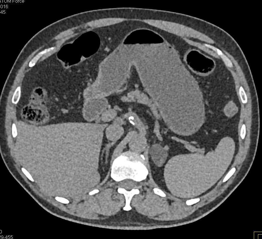 Left Adrenal Adenoma - CTisus CT Scan