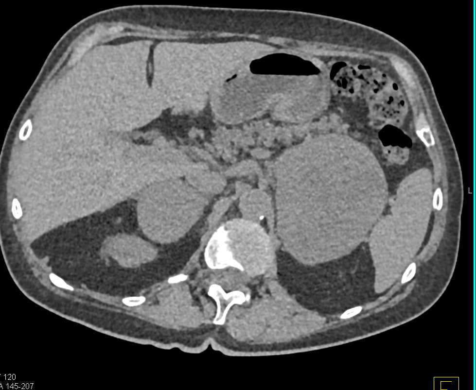 Metastatic Melanoma to the Adrenal Glands - CTisus CT Scan