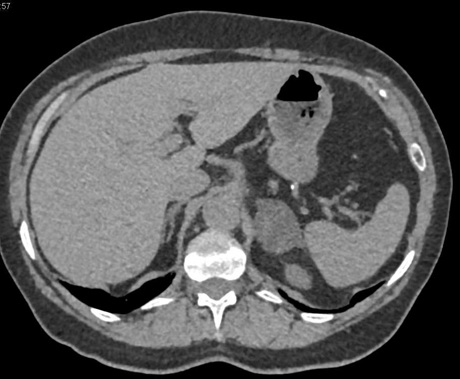 Left Adrenal Adenoma - CTisus CT Scan