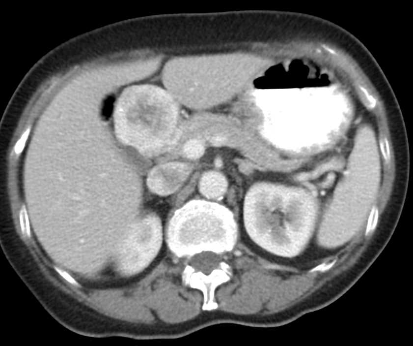 Paraganglioma Simulates a Pancreatic Mass - CTisus CT Scan