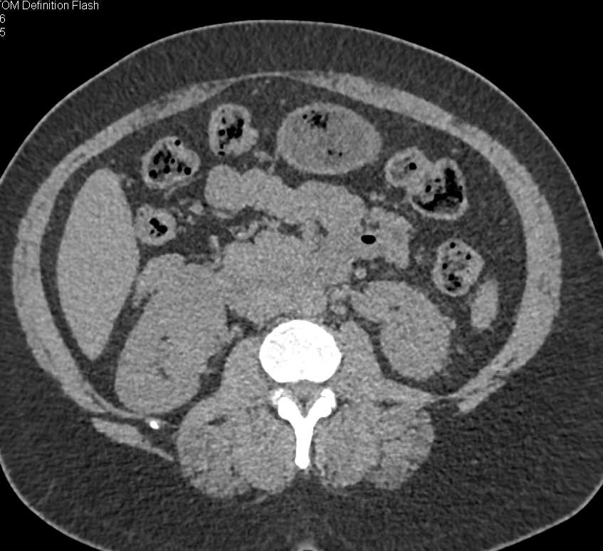 Atypical Papillary Renal Cell Carcinoma - CTisus CT Scan