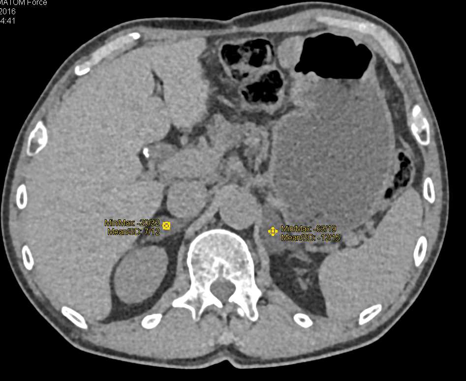 Incidental Adrenal Adenomas in a Patient with Bladder Cancer - CTisus CT Scan