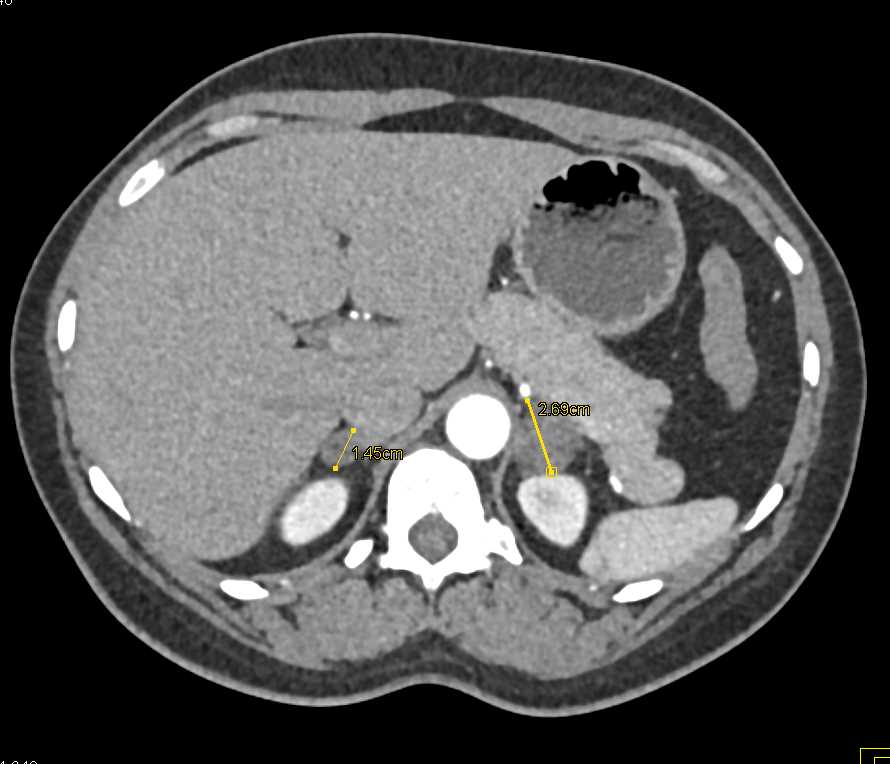 Bilateral Adrenal Adenomas - CTisus CT Scan