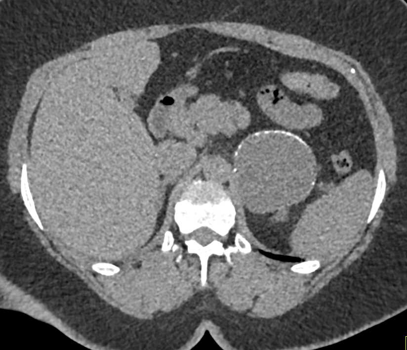 Partially calcified Old Hematoma of the Left Adrenal - CTisus CT Scan