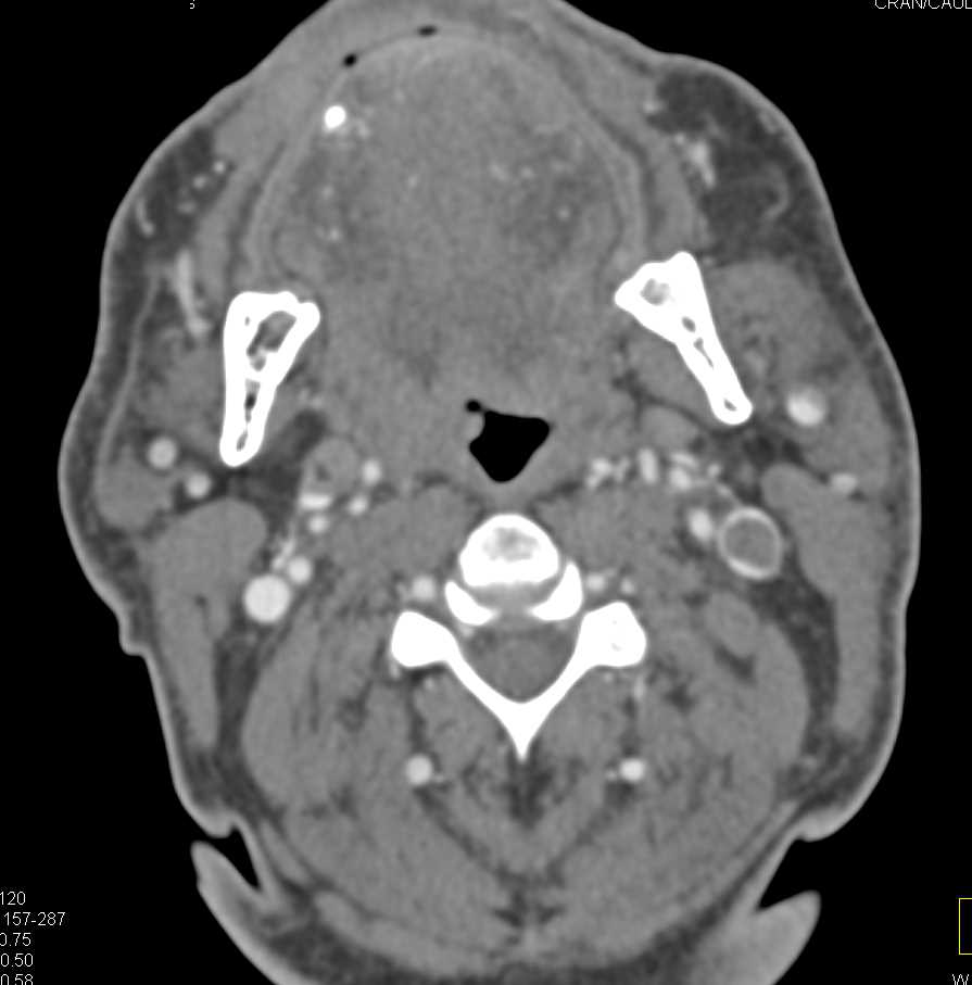 Jugular Vein Thrombosis Bilaterally - CTisus CT Scan