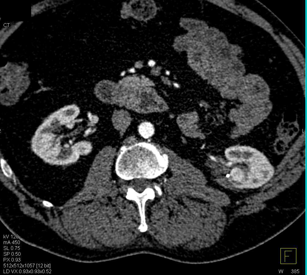 Metastatic Renal Cell Carcinoma Of The Adrenals And Contralateral