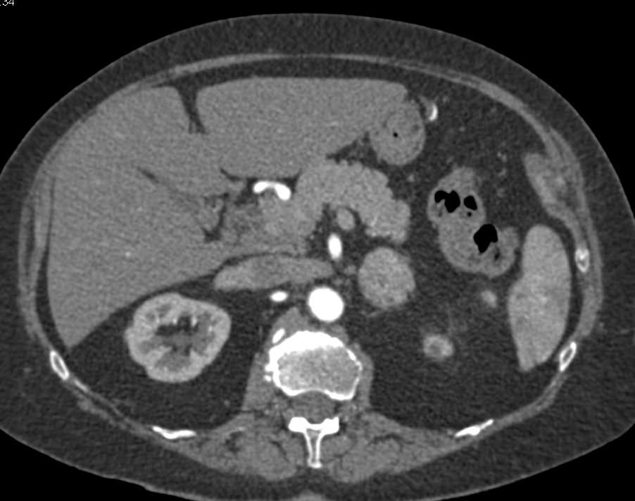 Left Adrenal Adenoma - CTisus CT Scan