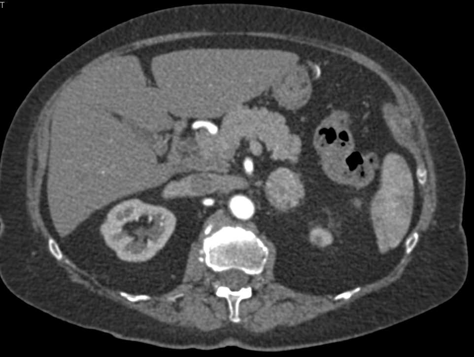 Lipid Poor Left Adrenal Adenoma - CTisus CT Scan