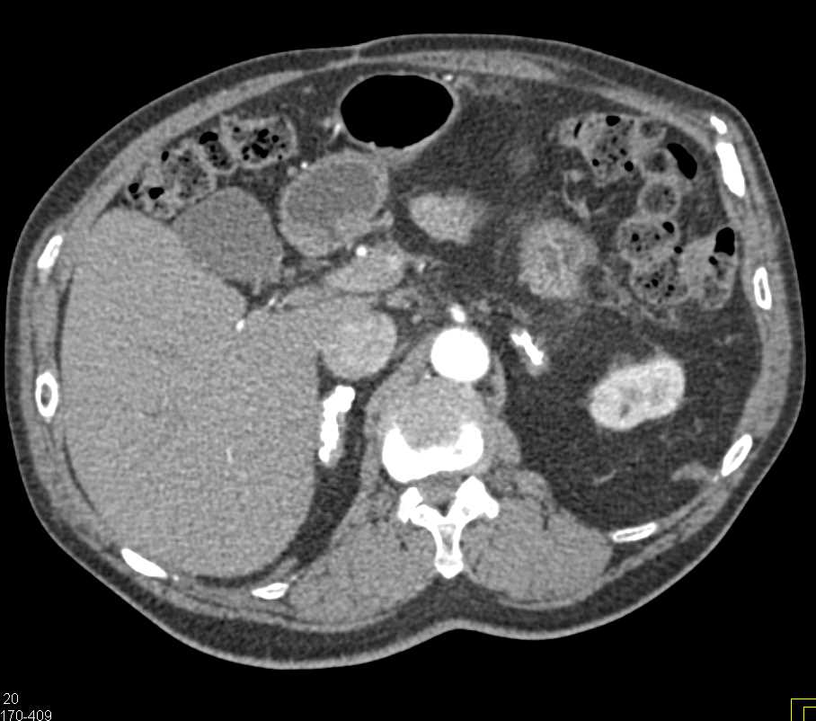 Calcified Adrenal Glands due to Prior Tuberculosis (TB) - CTisus CT Scan