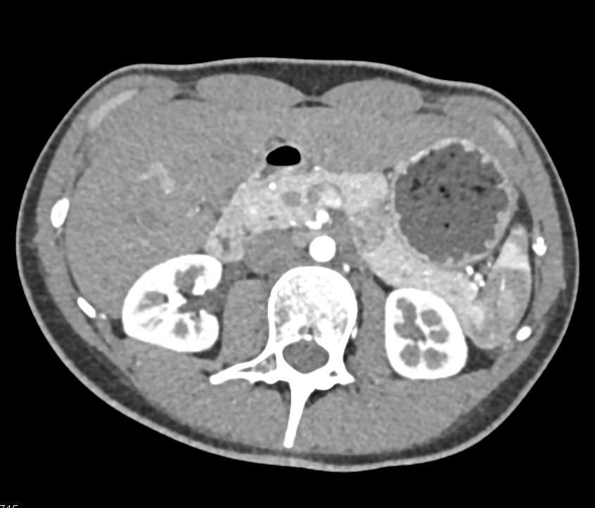 Cystic Pancreatic Neuroendocrine Tumor (PNET) Pancreas - CTisus CT Scan