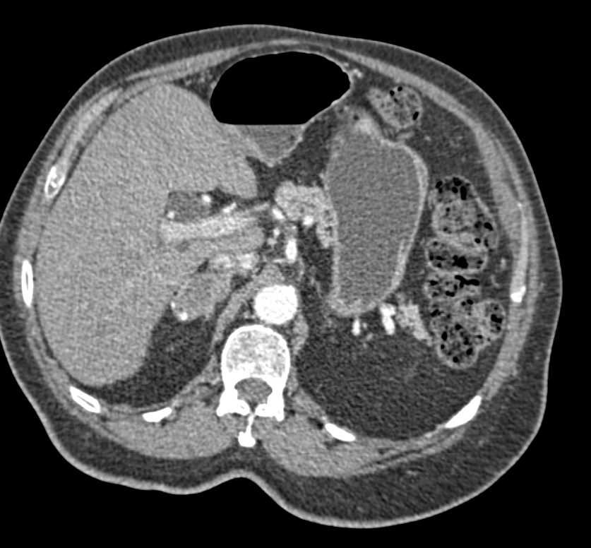 2cm Right Adrenal Adenoma - CTisus CT Scan