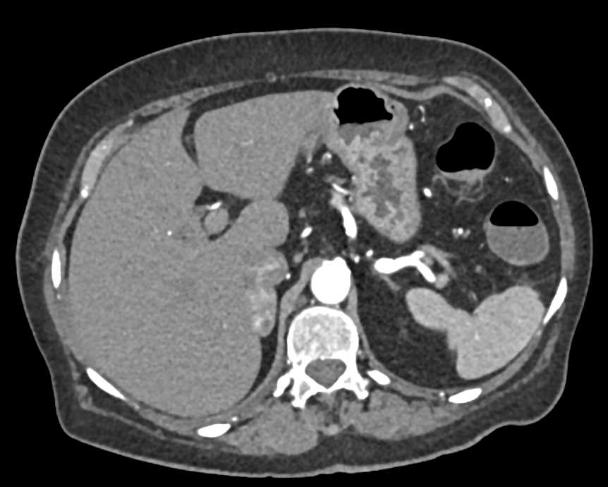 Metastastic Renal Cell carcinoma to the Right Adrenal - CTisus CT Scan