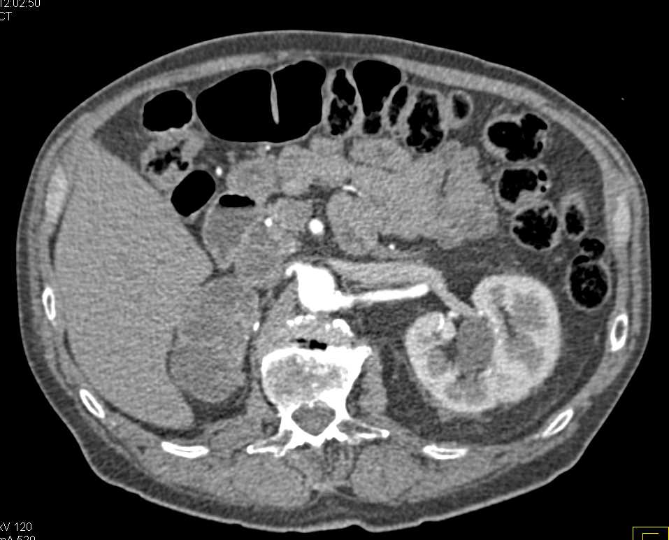 Metastatic Renal Cell Carcinoma (RCC) to the Adrenal Glands - CTisus CT Scan