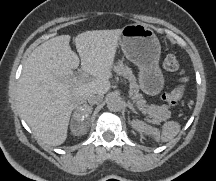 Myelolipoma Right Adrenal Gland - CTisus CT Scan