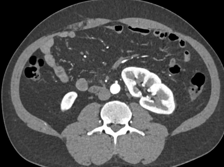 Hematoma Left Adrenal Bed - CTisus CT Scan