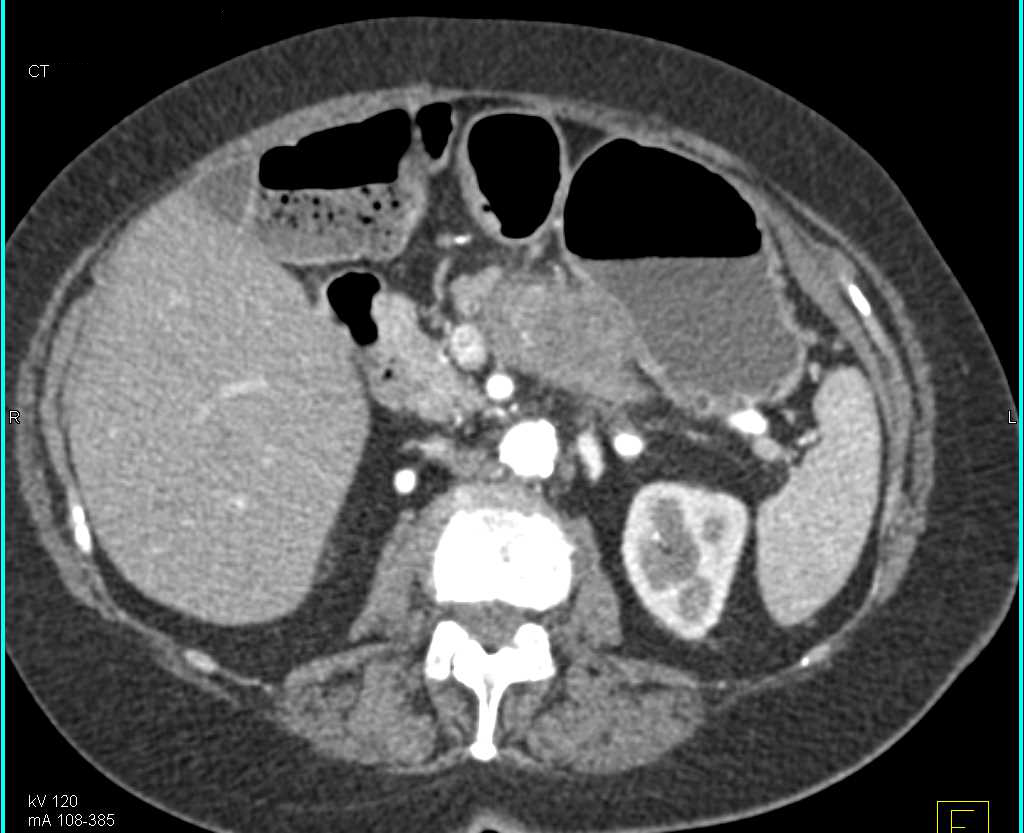 Pancreas Adenocarcinoma - CTisus CT Scan