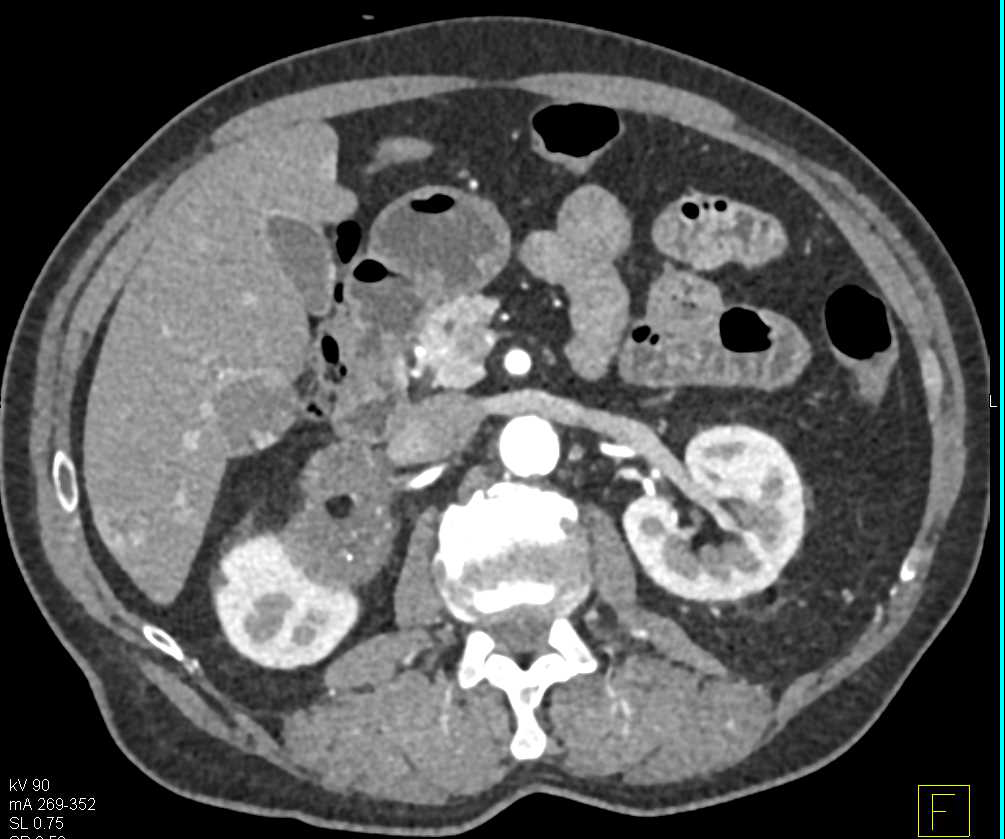 Right Adrenal Myelolipoma - CTisus CT Scan