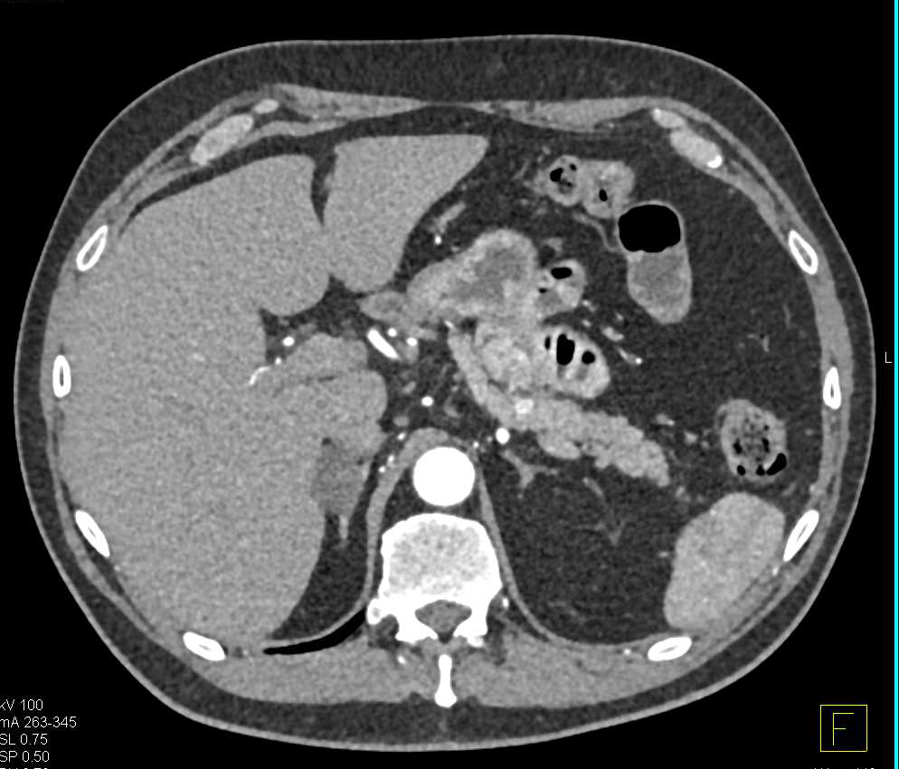 Right Adrenal Adenoma - CTisus CT Scan