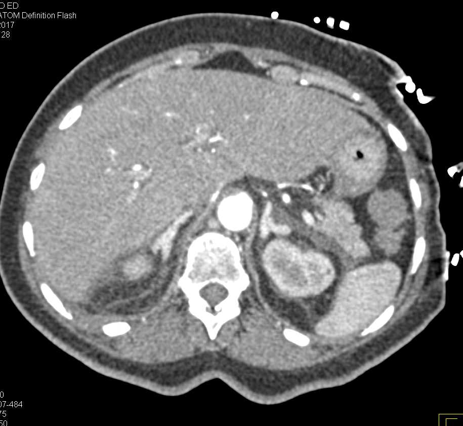 Bright Adrenals due to Hypotension - CTisus CT Scan