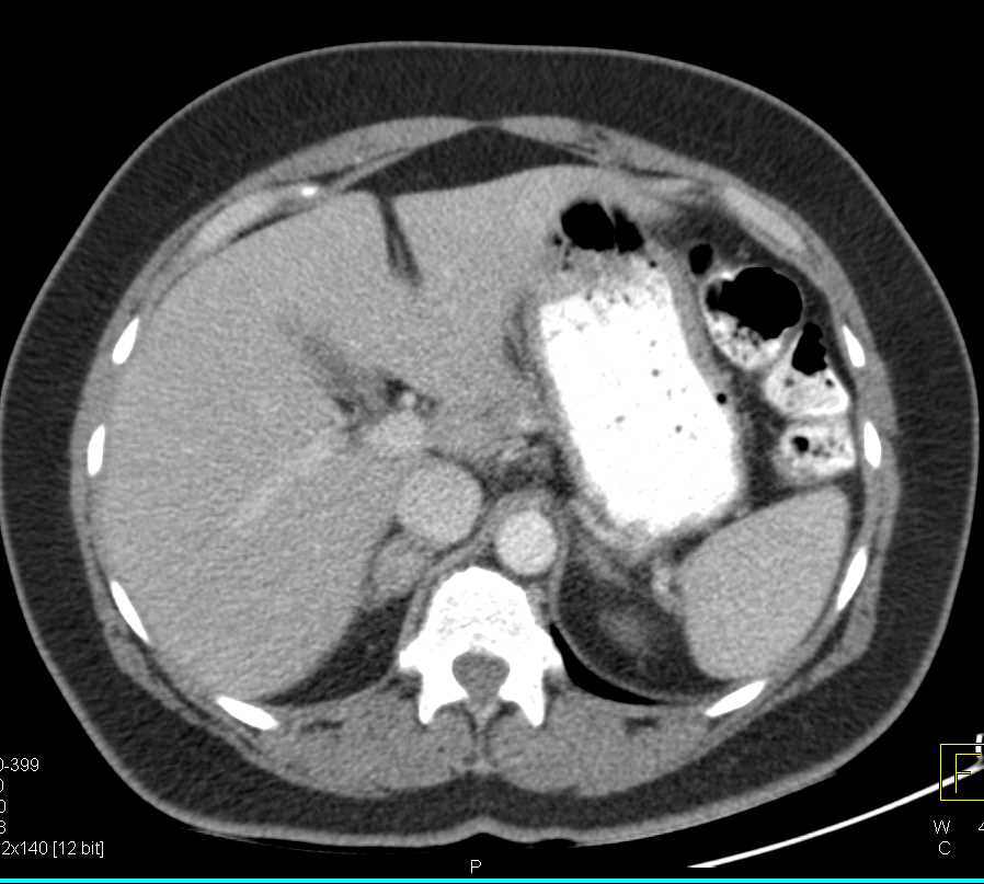 Bilateral Adrenal Adenomas - CTisus CT Scan