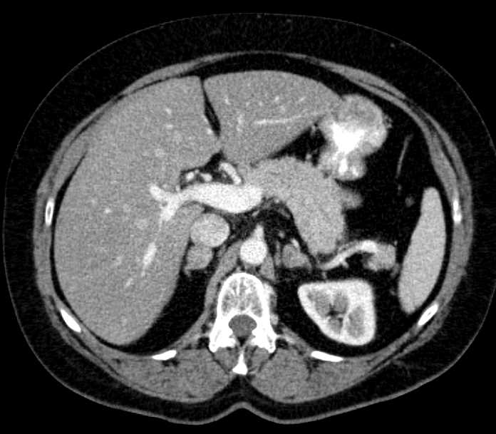 Bilateral Adrenal Pheochromocytomas - CTisus CT Scan