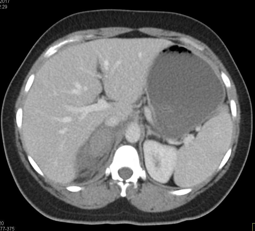 Acute Right Adrenal Hemorrhage and Follow Up - CTisus CT Scan