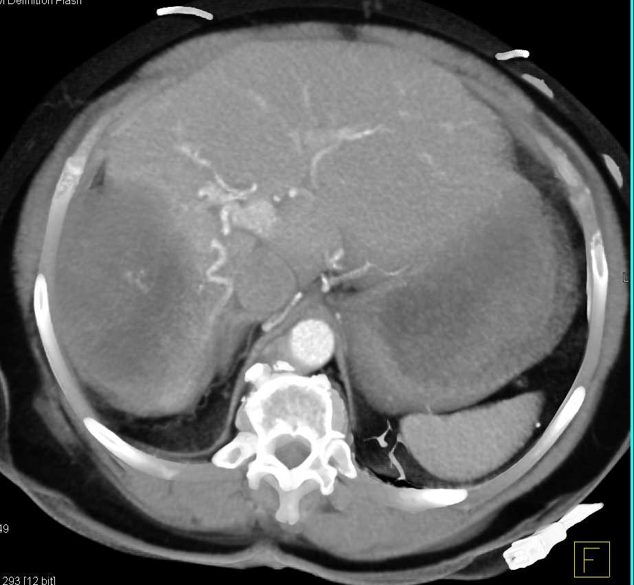 Liver Abscess Simulates a Tumor - CTisus CT Scan