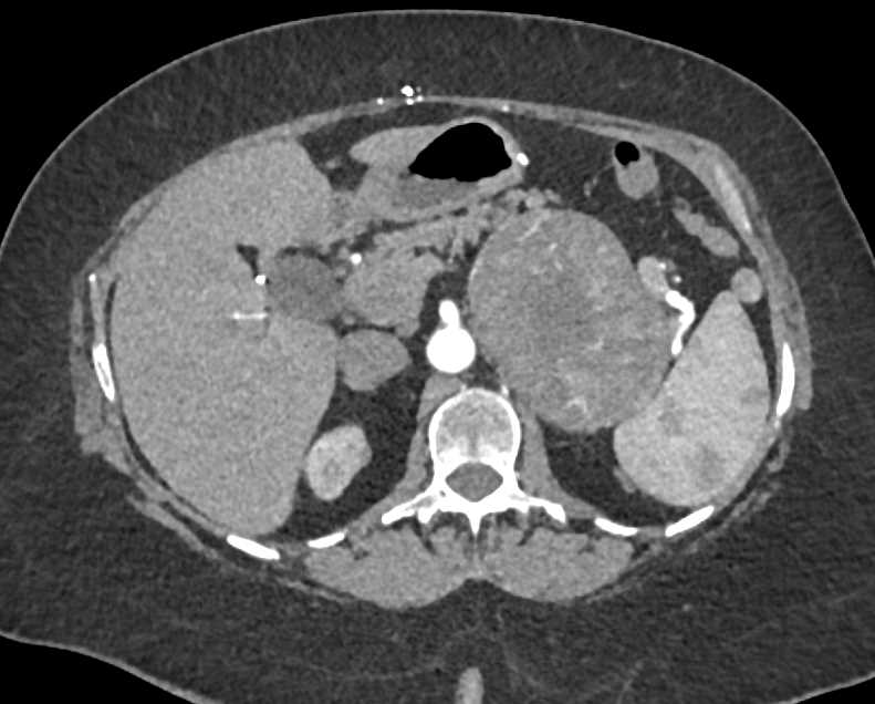 Left Adrenal Adenocarcinoma - CTisus CT Scan