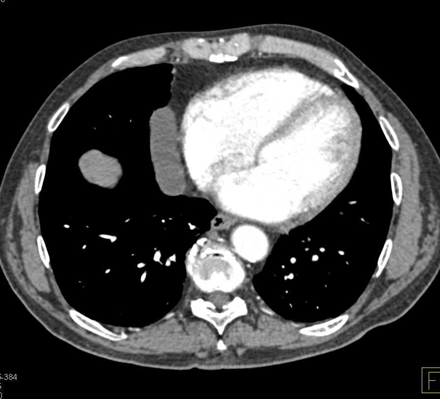 Incidental Pericardial cyst in Patient with Left Adrenal Pheo - CTisus CT Scan