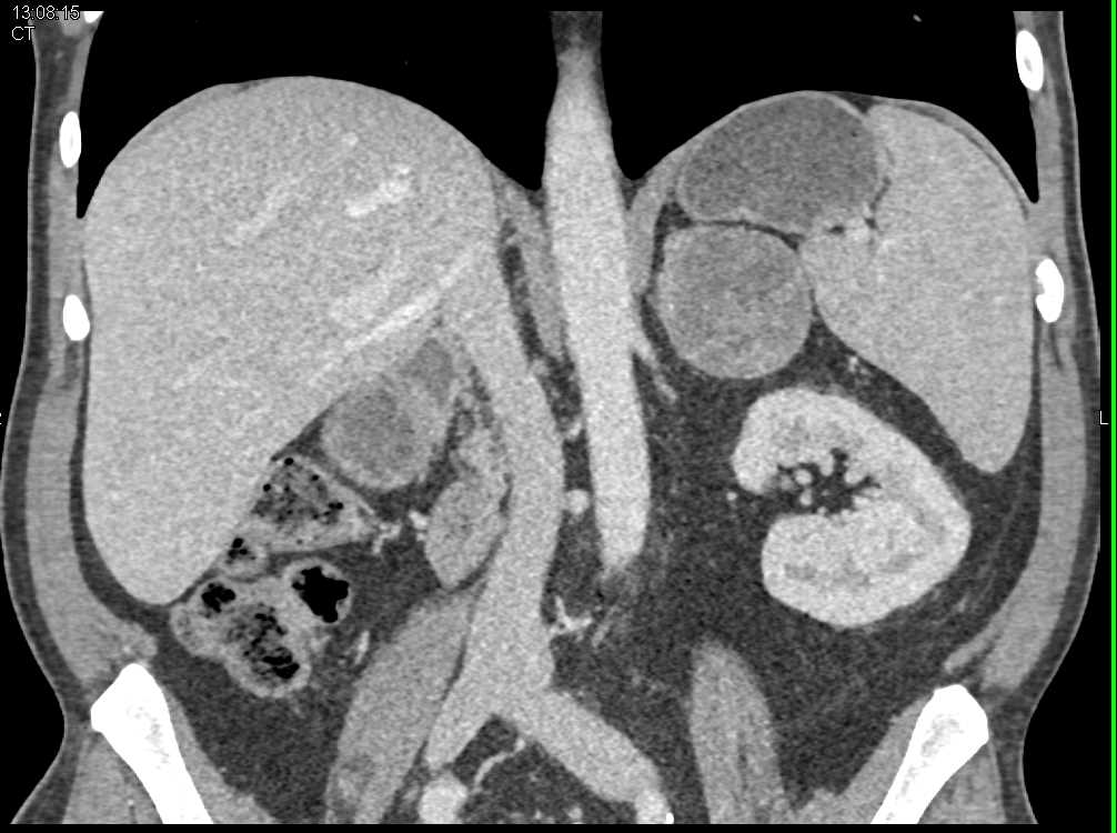 Atypical Adrenal Adenoma - CTisus CT Scan