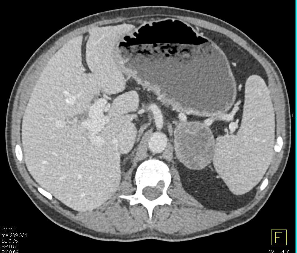 Atypical Adrenal Adenoma - CTisus CT Scan