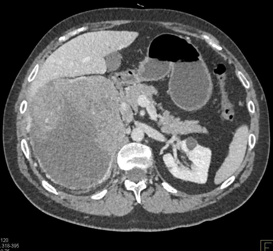 Primary Adrenal Carcinoma - CTisus CT Scan