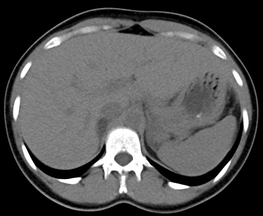 Right Adrenal Adenoma - CTisus CT Scan