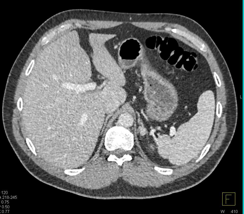 1cm Adenoma Left Adrenal - CTisus CT Scan