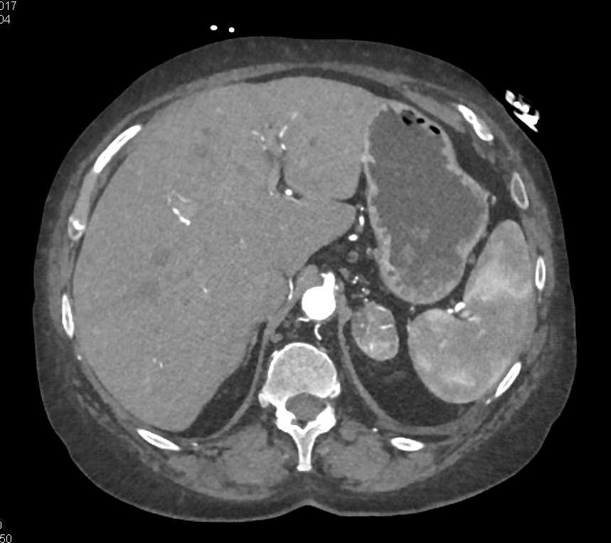 Adrenal Myelolipoma - CTisus CT Scan