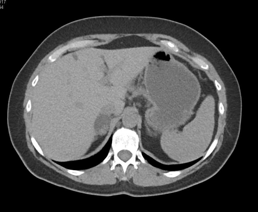 Right Adrenal Adenoma - CTisus CT Scan