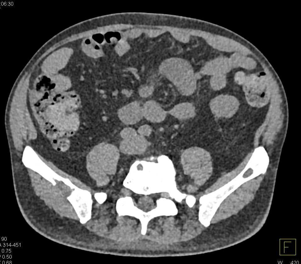 Adrenal Carcinoma Metastatic to Bone - CTisus CT Scan
