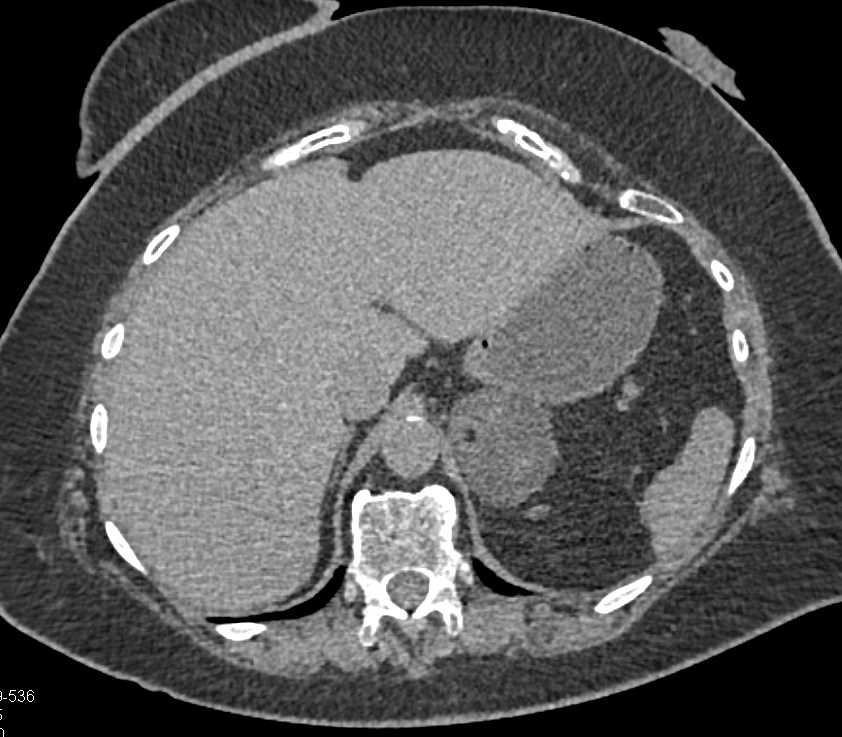 Left Adrenal Myelolipoma - CTisus CT Scan