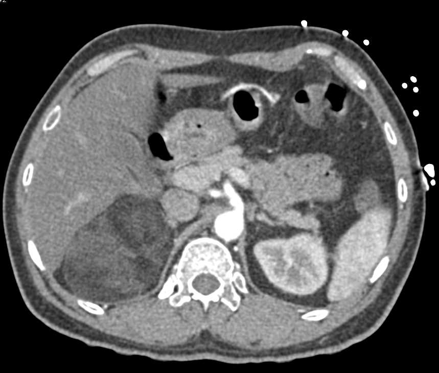 Adrenal Myelolipoma - CTisus CT Scan