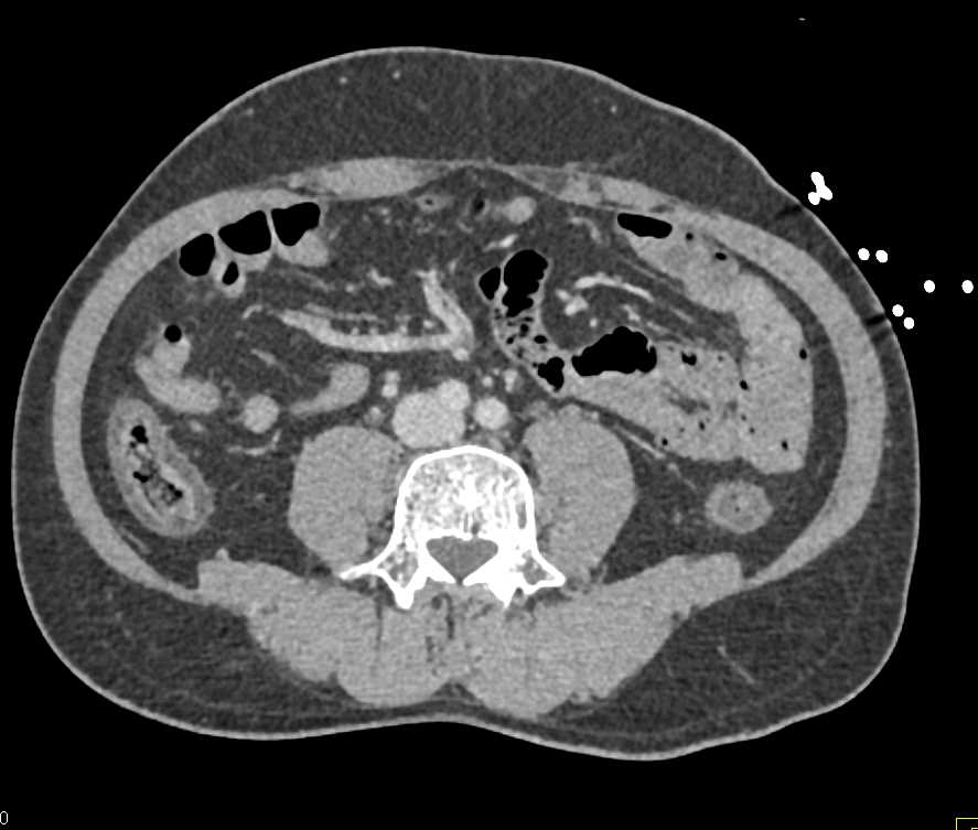 Adrenal Myelolipoma - CTisus CT Scan