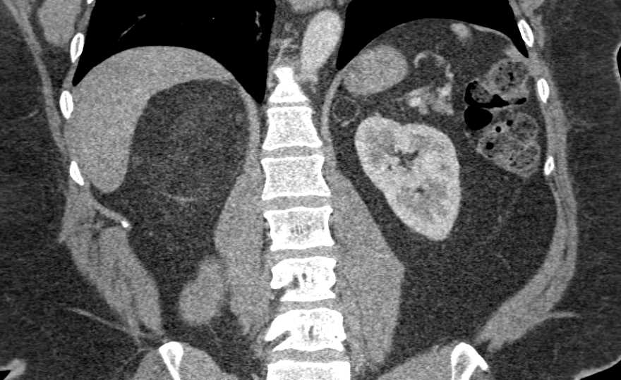 Right Adrenal Myelolipoma - CTisus CT Scan