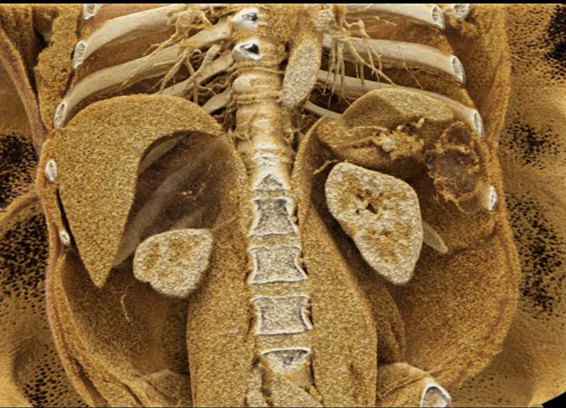 Right Adrenal Myelolipoma - CTisus CT Scan