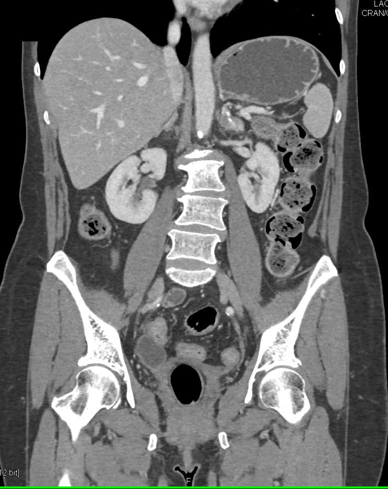 Pheochromocytoma Left Adrenal Gland - CTisus CT Scan