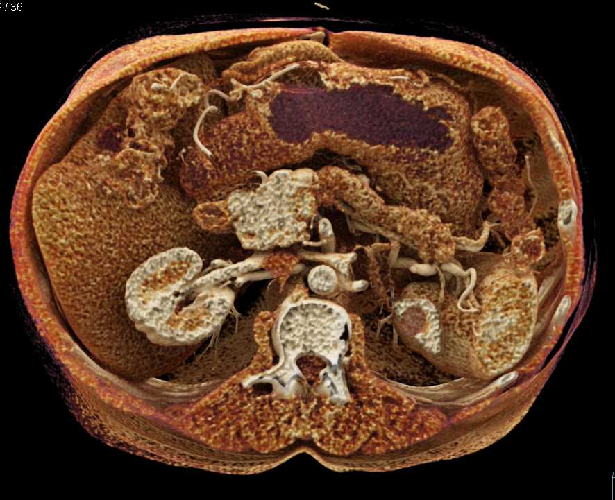 Carcinoma Body of the Pancreas - CTisus CT Scan